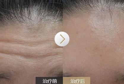 去抬頭紋前后對比圖，去抬頭紋手術多少錢？