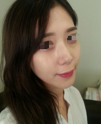 果酸嫩膚多少錢?我做成890元,果圖分享給大家