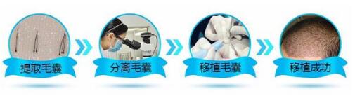 頭發(fā)移植需要多少錢？靠譜嗎？