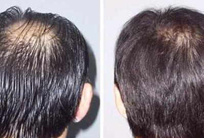 頭發(fā)移植需要多少錢？靠譜嗎？