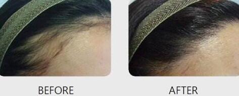 頭發(fā)移植需要多少錢？靠譜嗎？