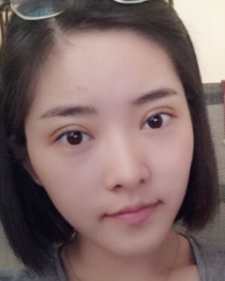 全切微創(chuàng)雙眼皮恢復(fù)圖，長(zhǎng)沙希美蔣松林手術(shù)案例