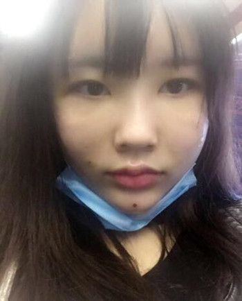 武漢美亞金國華醫(yī)生幫我做的自體脂肪全臉填充果恢復(fù)案例
