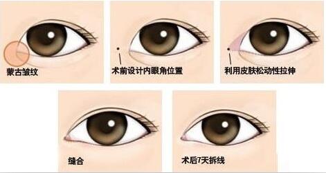 開內(nèi)眼角原理圖，開眼角大約多少錢