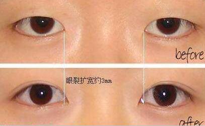 開內(nèi)眼角+割雙眼皮，開眼角多少錢