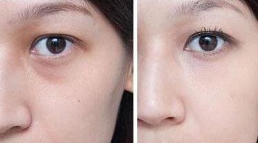 超聲波去眼袋前后對比圖，超聲波去眼袋多少錢？