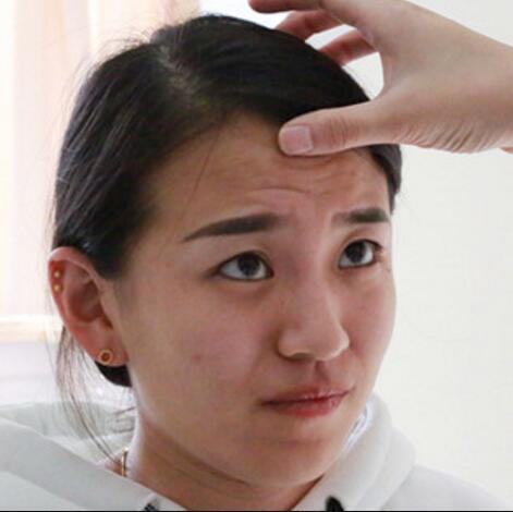 注射瘦臉去抬頭紋眉間紋恢復(fù)過程圖,真實(shí)案例分享
