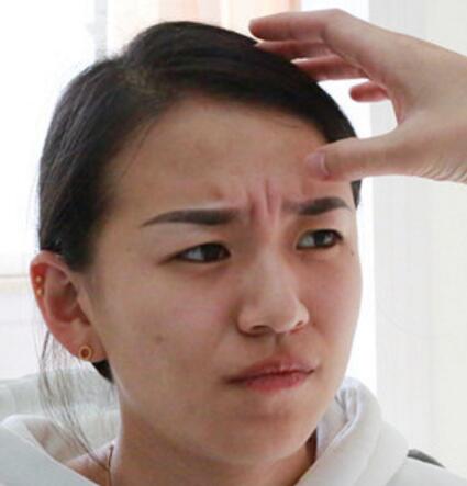 注射瘦臉去抬頭紋眉間紋恢復(fù)過程圖,真實(shí)案例分享