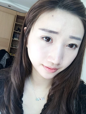濰坊華美童艷梅醫(yī)生做的面部脂肪填充，大家來看看果怎么樣