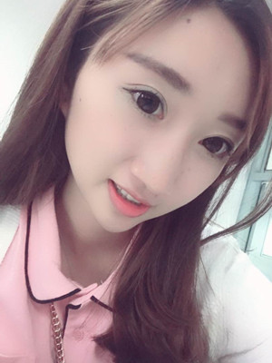 濰坊華美童艷梅醫(yī)生做的面部脂肪填充，大家來看看果怎么樣