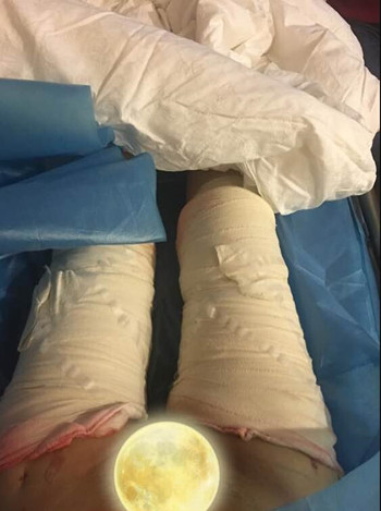 廣州美萊羅延平做的大腿環(huán)吸整形恢復(fù)果過程案例