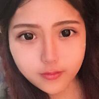 切開(kāi)雙眼皮+開(kāi)眼角前后對(duì)比圖和恢復(fù)過(guò)程分享