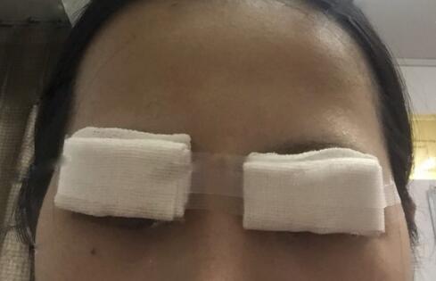 切開雙眼皮+開眼角前后對(duì)比圖和恢復(fù)過程分享