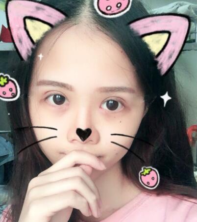 切開雙眼皮+開眼角前后對(duì)比圖和恢復(fù)過程分享