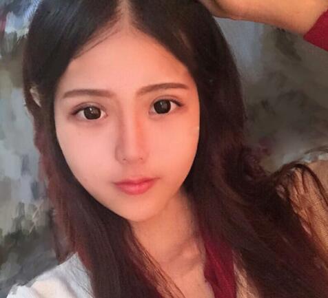 切開雙眼皮+開眼角前后對(duì)比圖和恢復(fù)過程分享