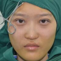 切開(kāi)雙眼皮多少錢(qián)？割雙眼皮真實(shí)案例多對(duì)比圖分享