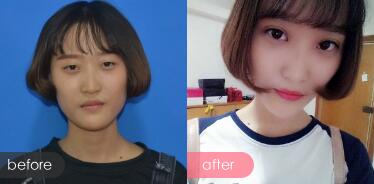 切開雙眼皮多少錢?割雙眼皮真實案例多對比圖分享