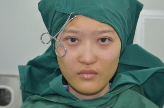 切開雙眼皮多少錢?割雙眼皮真實案例多對比圖分享