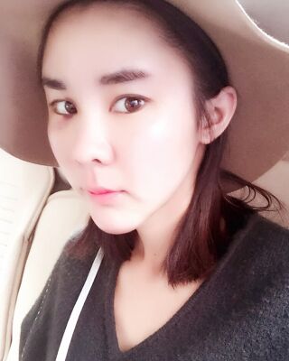 自體脂肪面部填充三個月果圖分享，減齡十歲