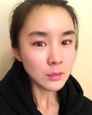 自體脂肪面部填充三個月果圖分享，減齡十歲