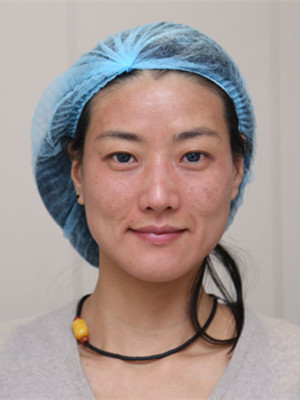 濟南愛容路傳燕醫(yī)生做的激光去黃褐斑，大家快來看看果如何