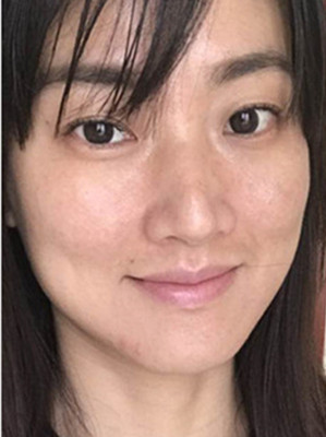 濟南愛容路傳燕醫(yī)生做的激光去黃褐斑，大家快來看看果如何