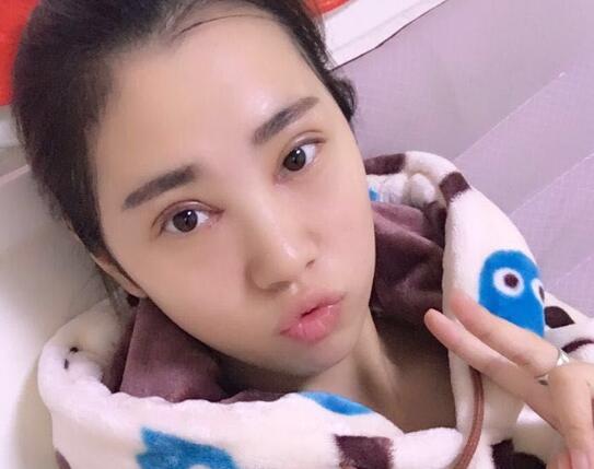 開眼角+割雙眼皮真實(shí)案例前后對(duì)比圖分享——四川悅好整形