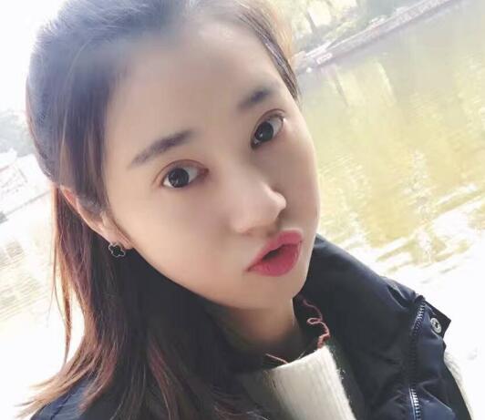 開眼角+割雙眼皮真實(shí)案例前后對(duì)比圖分享——四川悅好整形