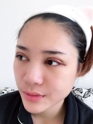 洛陽維多利亞歐式雙眼皮手術(shù)恢復(fù)過程圖，真實案例圖