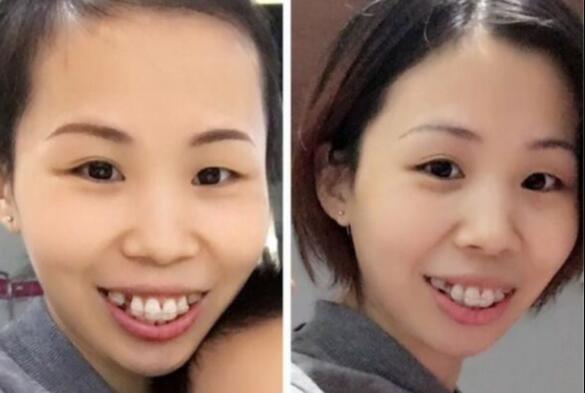 牙齒矯正的很好的年齡，多對(duì)比圖真實(shí)案例分享——成都格林口腔