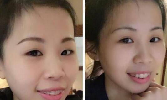 牙齒矯正的很好的年齡，多對(duì)比圖真實(shí)案例分享——成都格林口腔