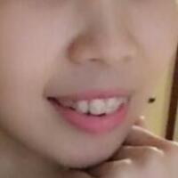 牙齒矯正的適宜年齡，多對比圖真實案例分享——成都格林口