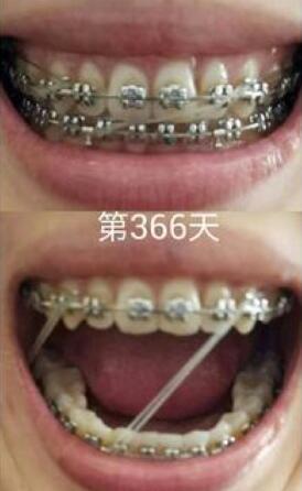 牙齒矯正前后對比圖，成人牙齒矯正費(fèi)用9800元——成都格林口腔醫(yī)院