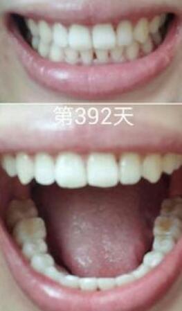 牙齒矯正前后對比圖，成人牙齒矯正費(fèi)用9800元——成都格林口腔醫(yī)院