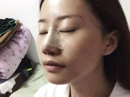假體隆鼻前后對比圖,假體隆鼻恢復(fù)時間2個月真實案例