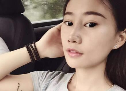 假體隆鼻前后對比圖,假體隆鼻恢復(fù)時間2個月真實案例