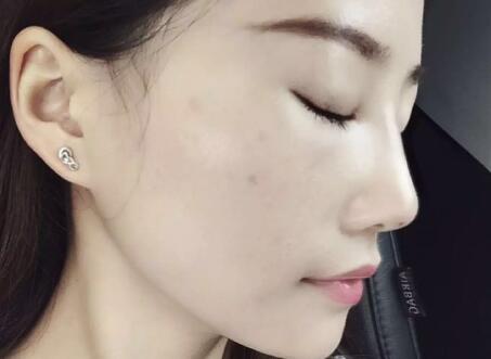 假體隆鼻前后對比圖,假體隆鼻恢復(fù)時間2個月真實案例