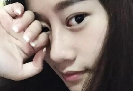 假體隆鼻前后對比圖,假體隆鼻恢復(fù)時間2個月真實案例