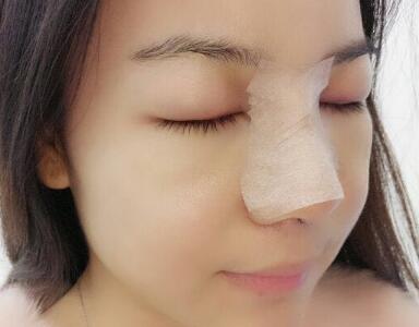 歪鼻子矯正整形恢復(fù)過程和對比圖分享——成都魅麗經(jīng)緯醫(yī)療