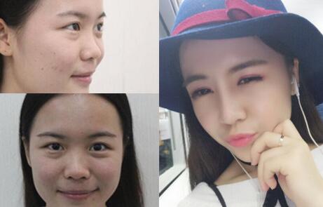 隆鼻整形前后對比圖,歪鼻子矯正整形恢復(fù)過程