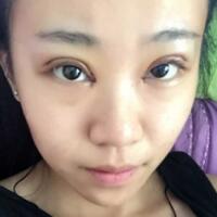 在成都魅麗經(jīng)緯做單眼皮變雙眼皮整形恢復(fù)過程和對(duì)比圖分享