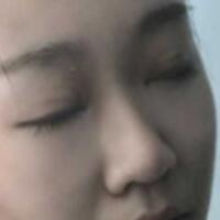 在成都魅麗經(jīng)緯做單眼皮變雙眼皮整形恢復(fù)過程和對(duì)比圖分享