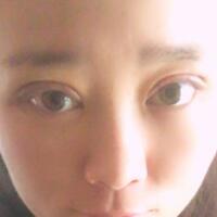 割雙眼皮前后對(duì)比圖和恢復(fù)過程——成都魅麗經(jīng)緯整形醫(yī)院