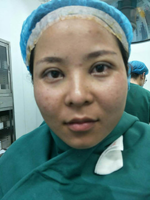 深圳南西子袁新平醫(yī)生做的割雙眼皮+開眼角前后恢復過程圖片分享