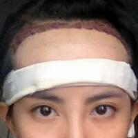 種頭發(fā)有用嗎？種植頭發(fā)恢復(fù)過程真實案例——南京明基醫(yī)院