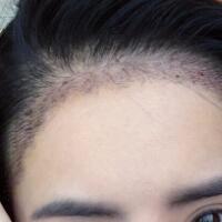 種頭發(fā)有用嗎？種植頭發(fā)恢復(fù)過程真實案例——南京明基醫(yī)院