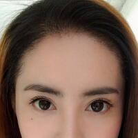 種頭發(fā)有用嗎？種植頭發(fā)恢復(fù)過程真實案例——南京明基醫(yī)院