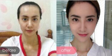 種頭發(fā)有用嗎?種植頭發(fā)恢復(fù)過(guò)程真實(shí)案例