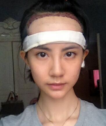 種頭發(fā)有用嗎?種植頭發(fā)恢復(fù)過(guò)程真實(shí)案例