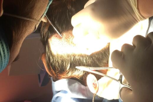 種頭發(fā)有用嗎?種植頭發(fā)恢復(fù)過(guò)程真實(shí)案例